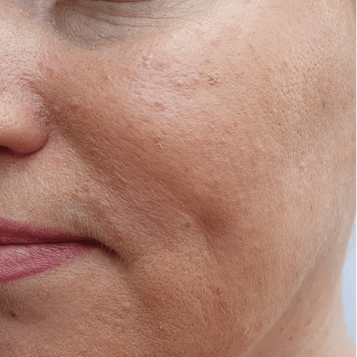 Skóra twarzy przed zabiegiem anti-aging – zmarszczki i utrata jędrności